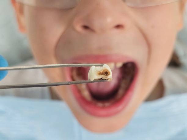 Best Pediatric Emergency Dentist in Staunton, IL